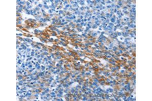Immunohistochemistry of Human thyroid cancer using PAK6 Polyclonal Antibody at dilution of 1:40 (PAK6 Antikörper)