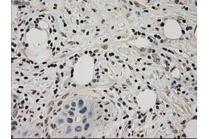 Immunohistochemical staining of paraffin-embedded Adenocarcinoma of ovary tissue using anti-LDHAmouse monoclonal antibody.