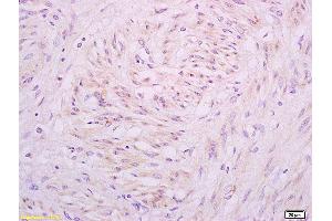 Formalin-fixed and paraffin embedded human cervical carcinoma tissue labeled with Anti A1BG Polyclonal Antibody,Unconjugated (ABIN872952) at 1:200 followed by conjugation to the secondary antibody and DAB staining. (A1BG Antikörper  (AA 301-400))