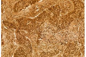 ABIN6264667 and ABIN6272905 at 1/100 staining Human lung cancer by IHC-P.