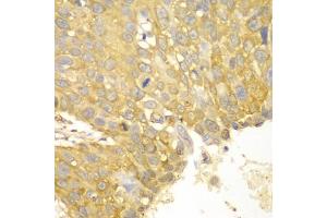 Immunohistochemistry of paraffin-embedded human lung cancer using ACTN1 antibody (ABIN5970506) at dilution of 1/100 (40x lens). (ACTN1 Antikörper)