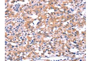 The image on the left is immunohistochemistry of paraffin-embedded Human thyroid cancer tissue using ABIN7190628(FAT1 Antibody) at dilution 1/40, on the right is treated with synthetic peptide. (FAT1 Antikörper)