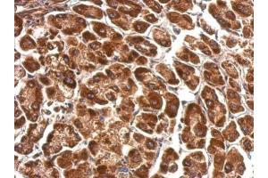 IHC-P Image Pyruvate Dehydrogenase E1 alpha antibody detects PDHA1 protein at cytosol on human hepatoma by immunohistochemical analysis. (Pyruvate Dehydrogenase E1 alpha (Center) Antikörper)