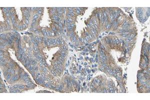 ABIN6274646 at 1/100 staining Human cervical cancer tissue by IHC-P. (CYP2C8 Antikörper)