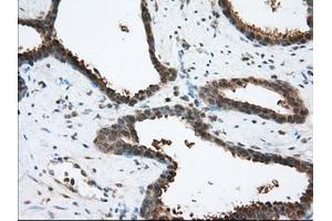 Immunohistochemical staining of paraffin-embedded Human prostate tissue using anti-ACAT2 mouse monoclonal antibody. (ACAT2 Antikörper)