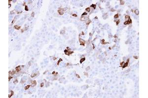 IHC-P Image Immunohistochemical analysis of paraffin-embedded OVCAR3 xenograft , using Carbonic anhydrase 2, antibody at 1:100 dilution. (CA2 Antikörper)