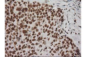 Immunohistochemical staining of paraffin-embedded Adenocarcinoma of Human breast tissue using anti-LOX mouse monoclonal antibody. (LOX Antikörper  (AA 22-168))