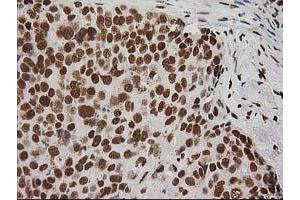 Immunohistochemical staining of paraffin-embedded Adenocarcinoma of Human breast tissue using anti-LOX mouse monoclonal antibody. (LOX Antikörper  (AA 22-168))
