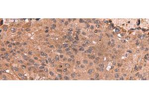 Immunohistochemistry of paraffin-embedded Human colorectal cancer tissue using IST1 Polyclonal Antibody at dilution of 1:40(x200) (IST1 Antikörper)