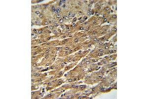 Formalin-fixed and paraffin-embedded human hepatocarcinoma with GPT Antibody (N-term ), which was peroxidase-conjugated to the secondary antibody, followed by DAB staining. (ALT Antikörper  (N-Term))