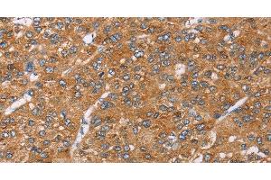 Immunohistochemistry of paraffin-embedded Human liver cancer using PAICS Polyclonal Antibody at dilution of 1:35