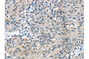 The image on the left is immunohistochemistry of paraffin-embedded Human breast cancer tissue using ABIN7129612(GLP2R Antibody) at dilution 1/30, on the right is treated with fusion protein. (GLP2R Antikörper)