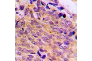 Immunohistochemical analysis of BAX staining in human breast cancer formalin fixed paraffin embedded tissue section. (BAX Antikörper  (Center))