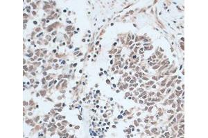 Immunohistochemistry of paraffin-embedded Human lung cancer using ZNF416 Polyclonal Antibody at dilution of 1:100 (40x lens).