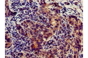 Immunohistochemistry of paraffin-embedded human pancreatic cancer using ABIN7144143 at dilution of 1:100 (SLC4A9 Antikörper  (AA 114-402))