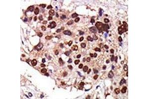 IHC analysis of FFPE human breast carcinoma tissue stained with the PKC nu antibody (PRKD3 Antikörper  (AA 352-384))