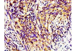 Immunohistochemistry of paraffin-embedded human pancreatic cancer using ABIN7155253 at dilution of 1:100 (HINT1 Antikörper  (AA 2-126))
