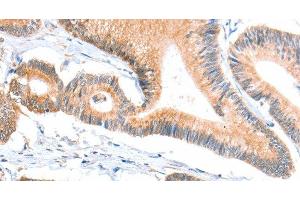 Immunohistochemistry of paraffin-embedded Human colon cancer tissue using ACSBG1 Polyclonal Antibody at dilution 1:40 (ACSBG1 Antikörper)