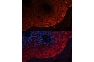 Immunofluorescence analysis of human skin cancer using S100 Polyclonal Antibody (ABIN3022395, ABIN3022396, ABIN3022397 and ABIN6218783) at dilution of 1:100 (40x lens). (S100A8 Antikörper  (AA 1-93))