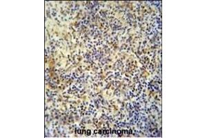 KRI1 antibody (N-term) (ABIN654199 and ABIN2844048) immunohistochemistry analysis in formalin fixed and paraffin embedded human lung carcinoma followed by peroxidase conjugation of the secondary antibody and DAB staining. (KRI1 Antikörper  (N-Term))