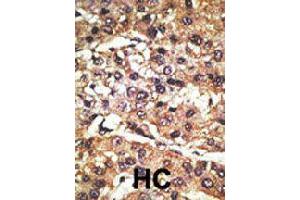 Formalin-fixed and paraffin-embedded human hepatocellular carcinoma tissue reacted with GPR37 polyclonal antibody  , which was peroxidase-conjugated to the secondary antibody, followed by DAB staining . (GPR37 Antikörper  (N-Term))