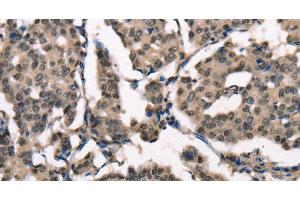 Immunohistochemistry of paraffin-embedded Human breast cancer using NSMCE3 Polyclonal Antibody at dilution of 1:40