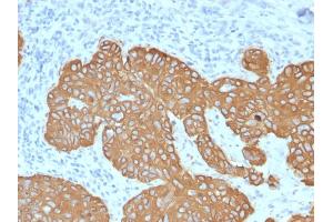 Formalin-fixed, paraffin-embedded human Basal Cell Carcinoma stained with Cytokeratin 5 (KRT5) Mouse Monoclonal Antibody (KRT5/2080).