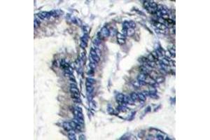 Formalin-fixed and paraffin-embedded human hepatocarcinoma reacted with DCAMKL1 Antibody (C-term) , which was peroxidase-conjugated to the secondary antibody, followed by DAB staining. (DCLK1 Antikörper  (C-Term))