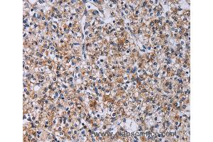 Immunohistochemistry of Human prostate cancer using CA4 Polyclonal Antibody at dilution of 1:30 (CA4 Antikörper)