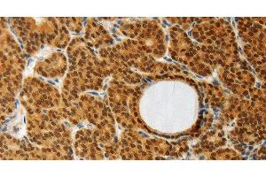 Immunohistochemistry of paraffin-embedded Human thyroid cancer using AKR1A1 Polyclonal Antibody at dilution of 1:30 (AKR1A1 Antikörper)