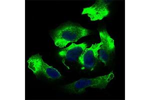 Immunohistochemical analysis of paraffin-embedded cervical cancer tissues using ALCAM antibody with DAB staining. (CD166 Antikörper  (AA 48-216))