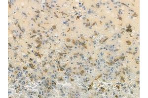 ABIN7093873 and ABIN7097916 at 1/100 staining human melanoma by IHC-P. (GALE Antikörper  (C-Term))