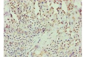 Immunohistochemistry of paraffin-embedded human breast cancer using ABIN7144294 at dilution of 1:100 (Annexin VII Antikörper  (AA 259-488))