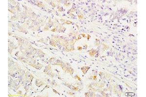 Formalin-fixed and paraffin embedded human gastric carcinoma labeled with Anti-MEK1/2(MAPKK1) Polyclonal Antibody, Unconjugated  at 1:200 followed by conjugation to the secondary antibody and DAB staining. (MEK1/2 Antikörper  (AA 301-393))