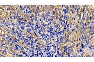 Detection of CASP1 in Human Breast cancer Tissue using Polyclonal Antibody to Caspase 1 (CASP1) (Caspase 1 Antikörper  (AA 317-404))