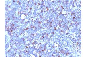 Formalin-fixed, paraffin-embedded human Lymphoma stained with CD43 Mouse Monoclonal Antibody (SPN/1094). (CD43 Antikörper)