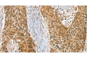 Immunohistochemistry of paraffin-embedded Human esophagus cancer using RAB27A Polyclonal Antibody at dilution of 1:30 (RAB27A Antikörper)