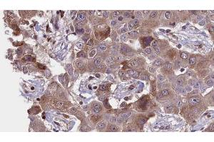 ABIN6276412 at 1/100 staining Human liver cancer tissue by IHC-P.