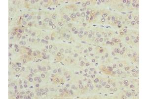 Immunohistochemistry of paraffin-embedded human liver cancer using ABIN7176441 at dilution of 1:100 (ZNF622 Antikörper  (AA 2-280))