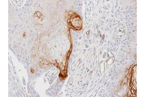 IHC-P Image Immunohistochemical analysis of paraffin-embedded Ca922 xenograft, using ENTPD6, antibody at 1:100 dilution. (ENTPD6 Antikörper  (Center))