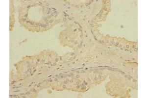 Immunohistochemistry of paraffin-embedded human prostata cancer using ABIN7171721 at dilution of 1:100 (CCDC79 Antikörper  (AA 301-550))