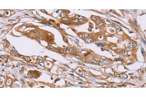 Immunohistochemistry of paraffin-embedded Human colon cancer using OS9 Polyclonal Antibody at dilution of 1:30 (OS9 Antikörper)