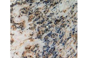 IHC-P analysis of Human Breast Cancer Tissue, with DAB staining. (CHI3L1 Antikörper  (AA 112-377))
