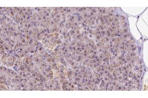 ABIN6273297 at 1/100 staining Human pancreas cancer tissue by IHC-P. (PIK3IP1 Antikörper  (N-Term))