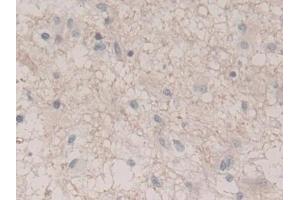 Detection of UCRP in Human Glioma Tissue using Polyclonal Antibody to Ubiquitin Cross Reactive Protein (UCRP) (CLRN1 Antisense RNA 1 (CLRN1-AS1) (AA 2-157) Antikörper)