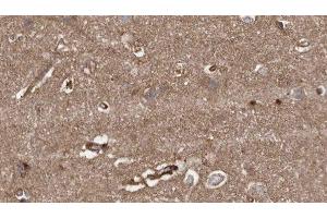 ABIN6279389 at 1/100 staining Human brain cancer tissue by IHC-P. (HACE1 Antikörper  (C-Term))