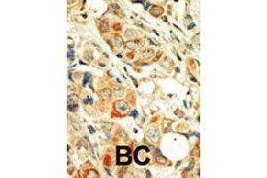 Formalin-fixed and paraffin-embedded human cancer tissue reacted with PRKCA polyclonal antibody  , which was peroxidase-conjugated to the secondary antibody, followed by DAB staining . (PKC alpha Antikörper  (C-Term))