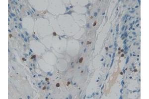 Detection of RNASE3 in Human Skin cancer Tissue using Polyclonal Antibody to Ribonuclease A3 (RNASE3) (RNASE3 Antikörper  (AA 30-154))