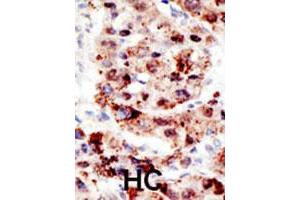 Formalin-fixed and paraffin-embedded human hepatocellular carcinoma tissue reacted with the UBB polyclonal antibody  , which was peroxidase-conjugated to the secondary antibody, followed by AEC staining. (Ubiquitin B Antikörper  (C-Term))