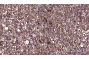 ABIN6276824 at 1/100 staining Human liver cancer tissue by IHC-P. (KIR2DL3 Antikörper)